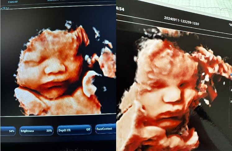 Gebelikte Dört Boyutlu (4D) Ultrasonografi Nedir?