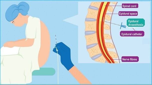 Ağrısız Normal Doğum Nedir? Nasıl Yapılır? Avantajları ve Riskleri Nelerdir?