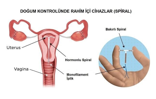 Spiral Nedir? Çeşitleri Nelerdir ve Nasıl Takılır?