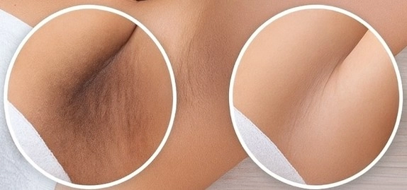 Genital Bölge Neden Koyulaşır? ve Renk Açma Nasıl Yapılır?